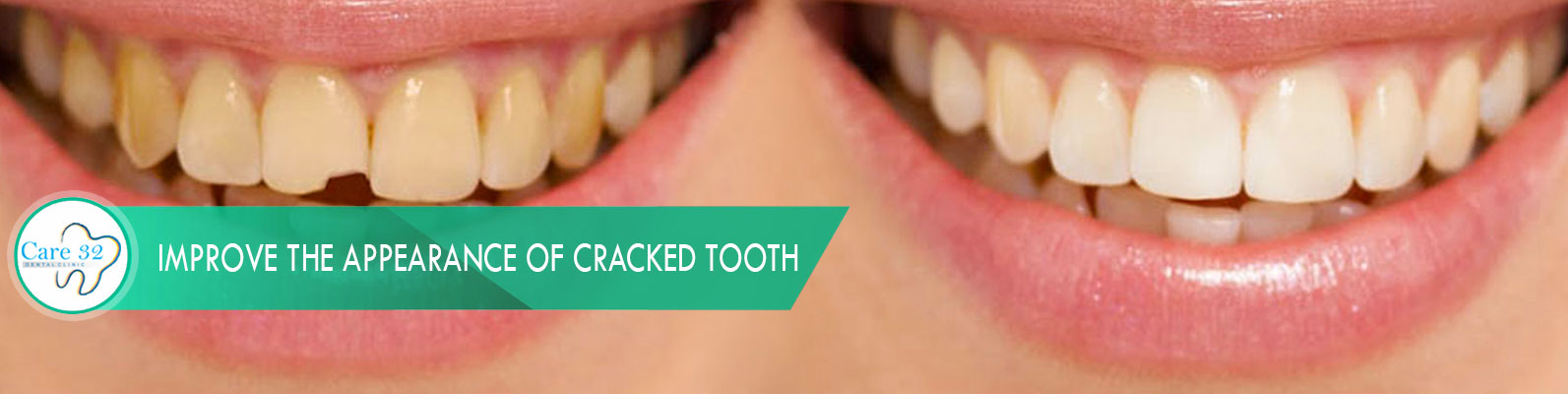 Cosmetic-Bonding-Andheri-East