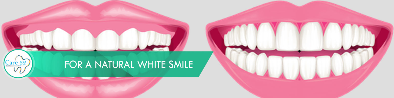 Crown-Lengthening-Treatment-Mumbai