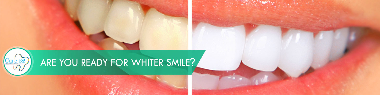 Teeth-Whitening-in-Andheri-Mumbai